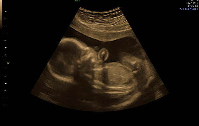 Ultrasound